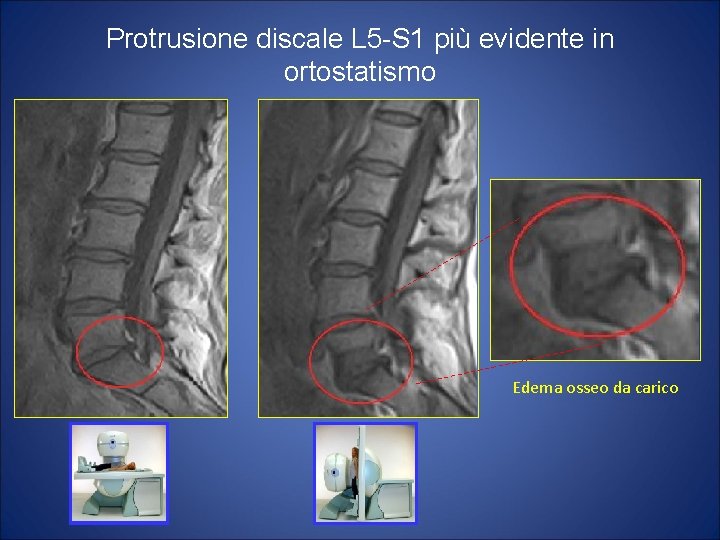 Protrusione discale L 5 -S 1 più evidente in ortostatismo Edema osseo da carico