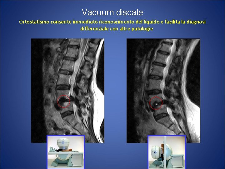 Vacuum discale Ortostatismo consente immediato riconoscimento del liquido e facilita la diagnosi differenziale con