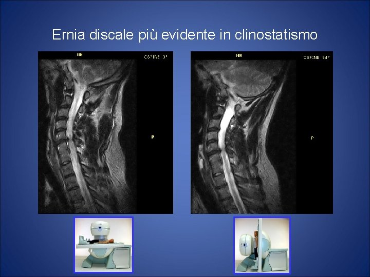 Ernia discale più evidente in clinostatismo 