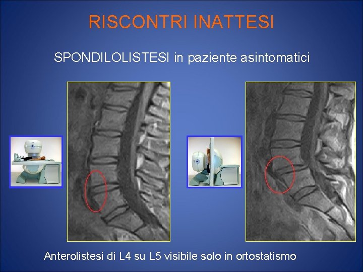 RISCONTRI INATTESI SPONDILOLISTESI in paziente asintomatici Anterolistesi di L 4 su L 5 visibile