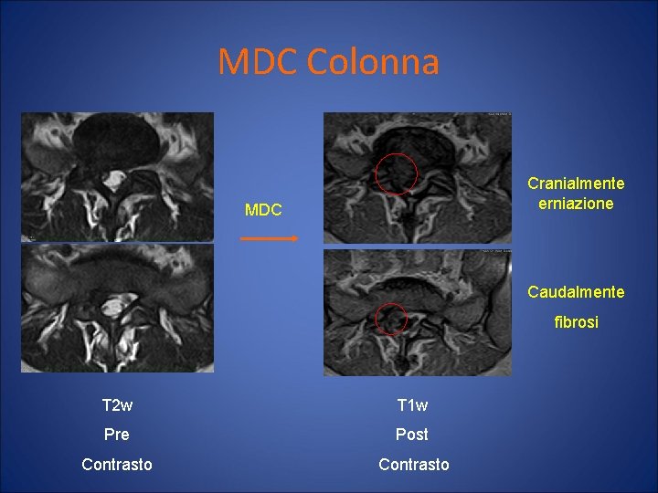 MDC Colonna Cranialmente erniazione MDC Caudalmente fibrosi T 2 w T 1 w Pre