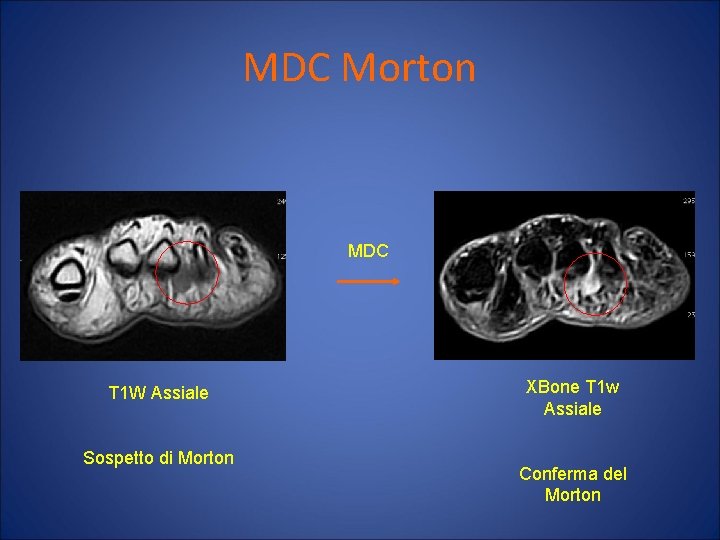 MDC Morton MDC T 1 W Assiale Sospetto di Morton XBone T 1 w