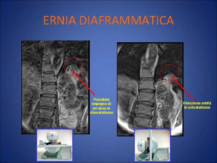 ERNIA DIAFRAMMATICA Possibile impegno di un’ansa in clinostatismo Riduzione entità in ortostatismo 