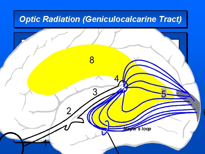 Optic Radiation (Geniculocalcarine Tract) Meyer’s loop 