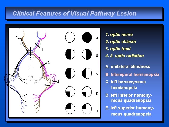 Clinical Features of Visual Pathway Lesion 1. optic nerve 2. optic chiasm 3. optic