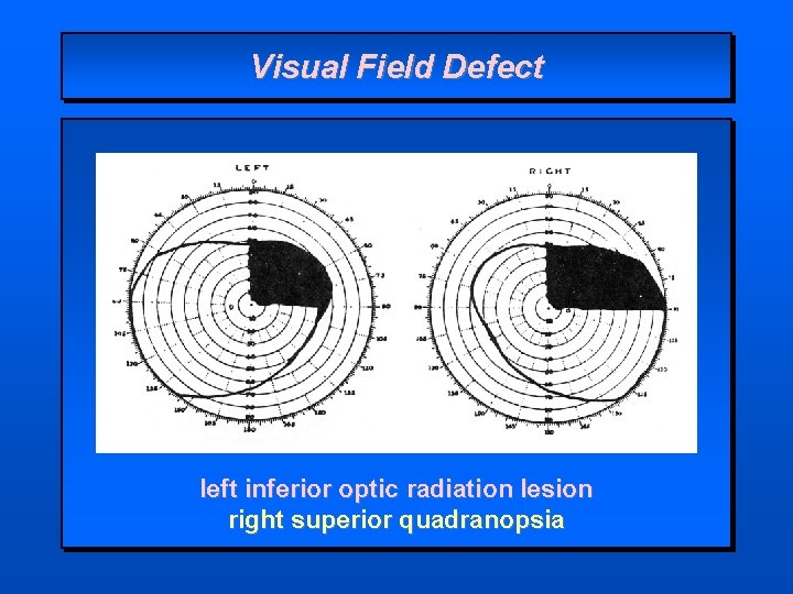 Visual Field Defect left inferior optic radiation lesion right superior quadranopsia 