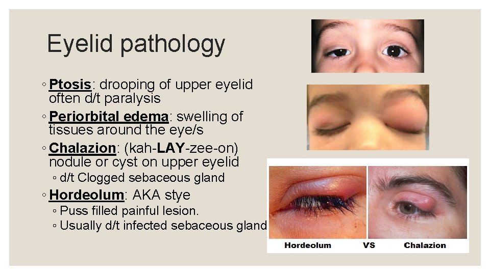 Eyelid pathology ◦ Ptosis: drooping of upper eyelid often d/t paralysis ◦ Periorbital edema: