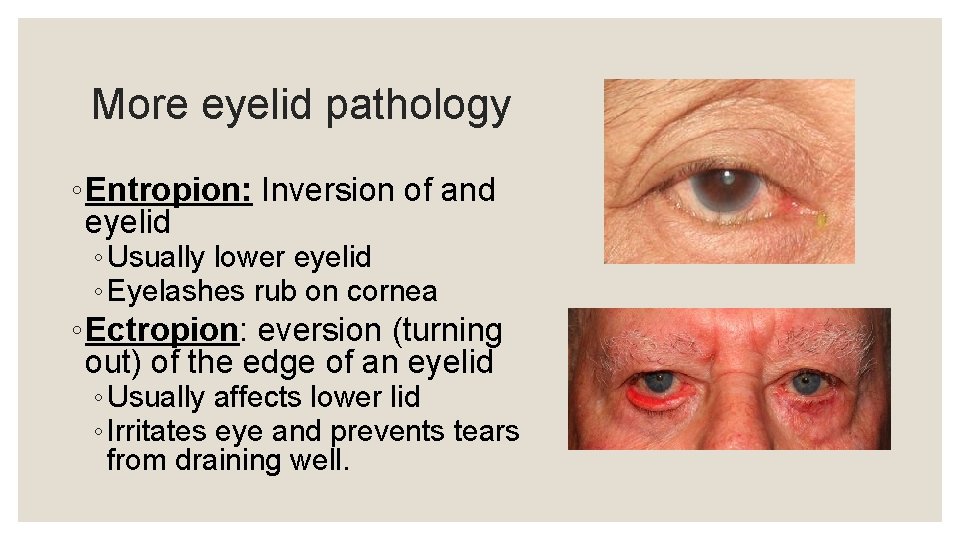 More eyelid pathology ◦ Entropion: Inversion of and eyelid ◦ Usually lower eyelid ◦