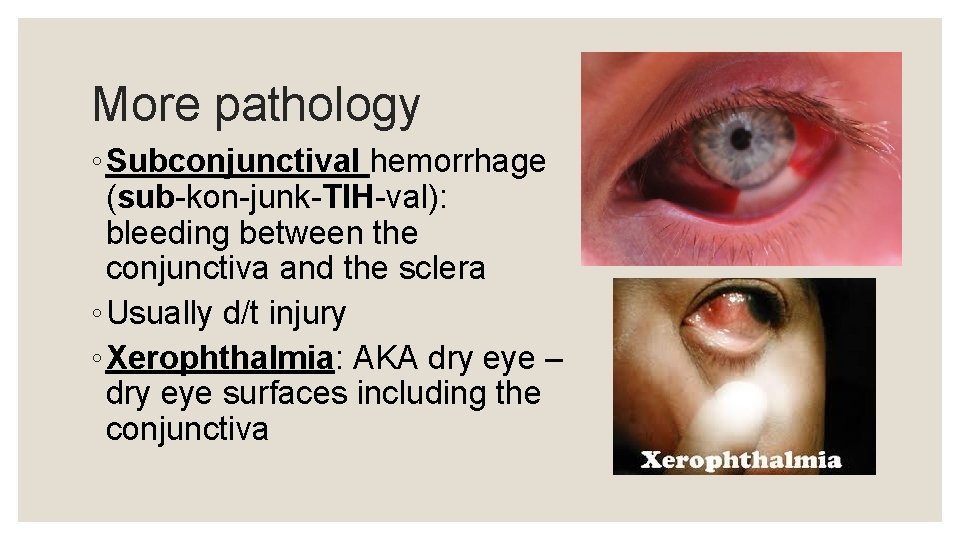 More pathology ◦ Subconjunctival hemorrhage (sub-kon-junk-TIH-val): bleeding between the conjunctiva and the sclera ◦
