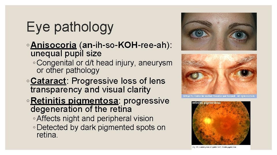 Eye pathology ◦ Anisocoria (an-ih-so-KOH-ree-ah): unequal pupil size ◦ Congenital or d/t head injury,