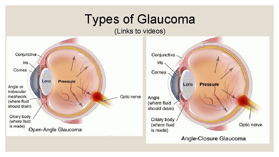 Types of Glaucoma (Links to videos) 