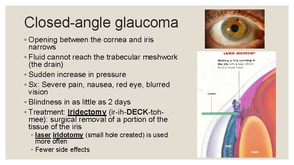 Closed-angle glaucoma ◦ Opening between the cornea and iris narrows ◦ Fluid cannot reach