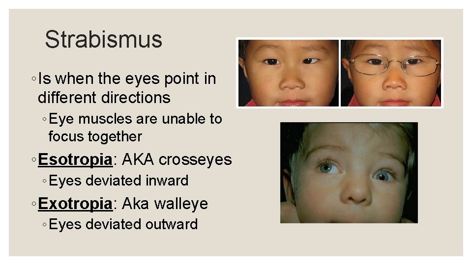 Strabismus ◦ Is when the eyes point in different directions ◦ Eye muscles are