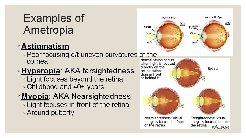 Examples of Ametropia ◦ Astigmatism ◦ Poor focusing d/t uneven curvatures of the cornea