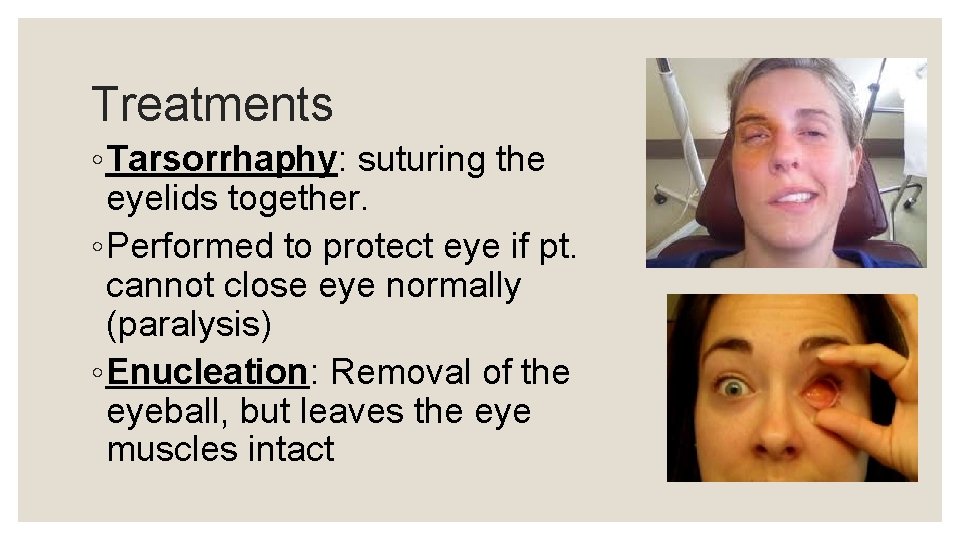 Treatments ◦ Tarsorrhaphy: suturing the eyelids together. ◦ Performed to protect eye if pt.