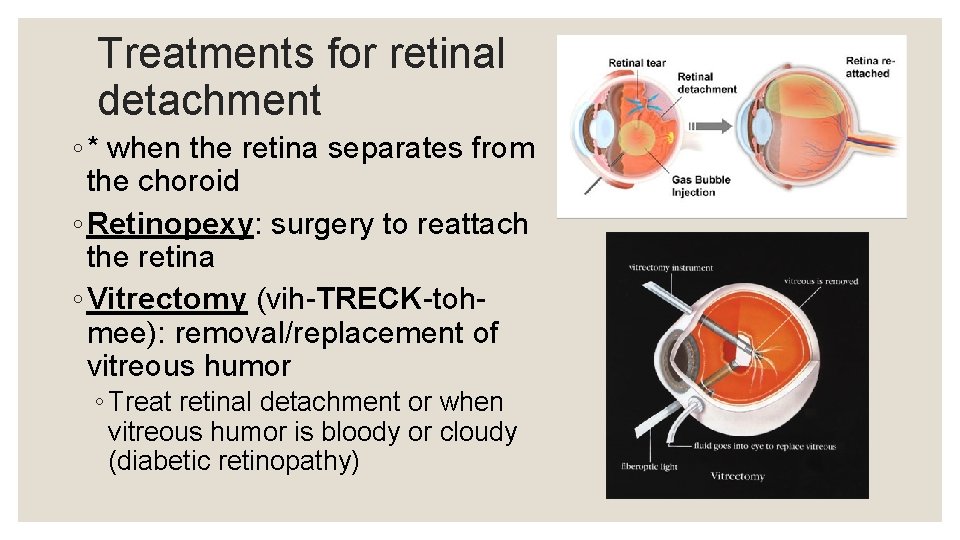 Treatments for retinal detachment ◦ * when the retina separates from the choroid ◦