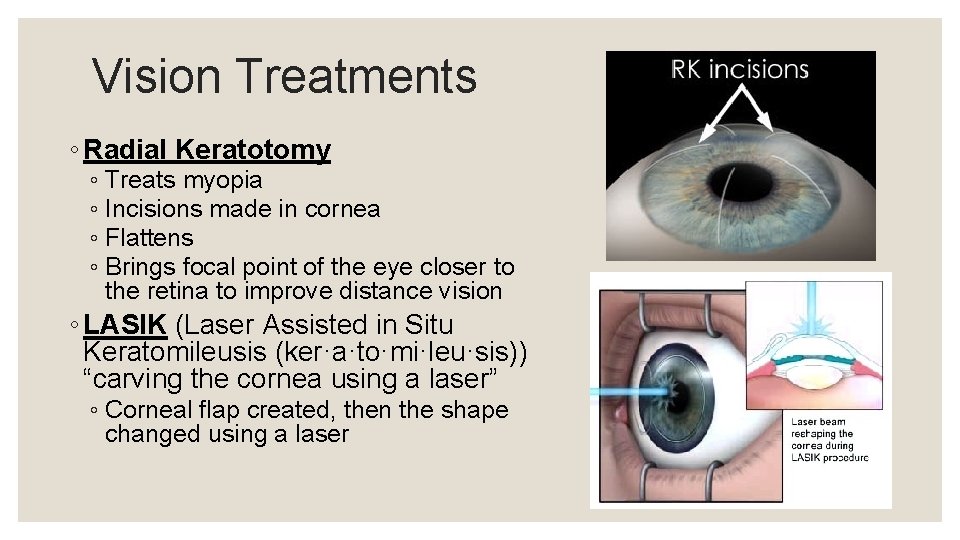 Vision Treatments ◦ Radial Keratotomy ◦ Treats myopia ◦ Incisions made in cornea ◦