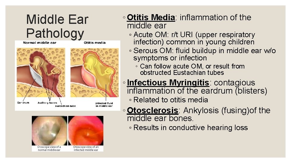 Middle Ear Pathology ◦ Otitis Media: inflammation of the middle ear ◦ Acute OM: