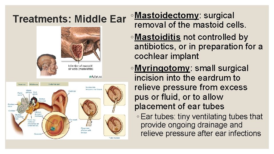 ◦ Mastoidectomy: surgical Treatments: Middle Ear removal of the mastoid cells. ◦ Mastoiditis not