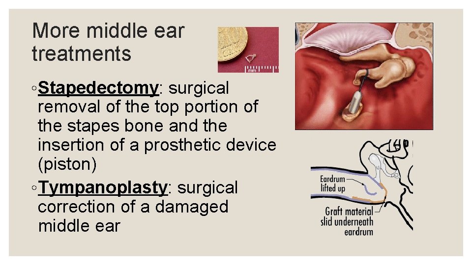 More middle ear treatments ◦ Stapedectomy: surgical removal of the top portion of the