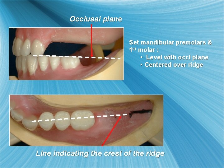 Occlusal plane Set mandibular premolars & 1 st molar : • Level with occl