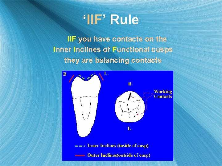 ‘IIF’ Rule IIF you have contacts on the Inner Inclines of Functional cusps they