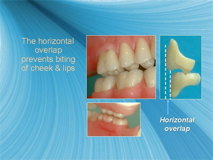 The horizontal overlap prevents biting of cheek & lips Horizontal overlap 