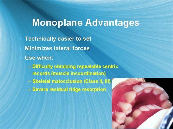 Monoplane Advantages • Technically easier to set • Minimizes lateral forces • Use when:
