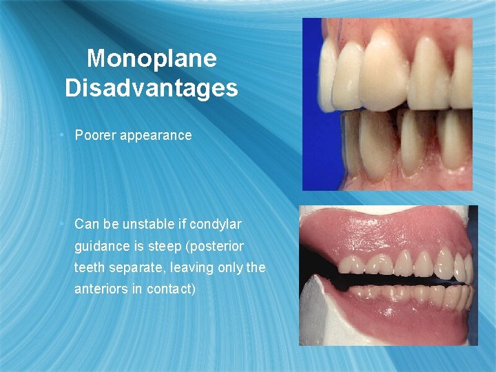Monoplane Disadvantages • Poorer appearance • Can be unstable if condylar guidance is steep