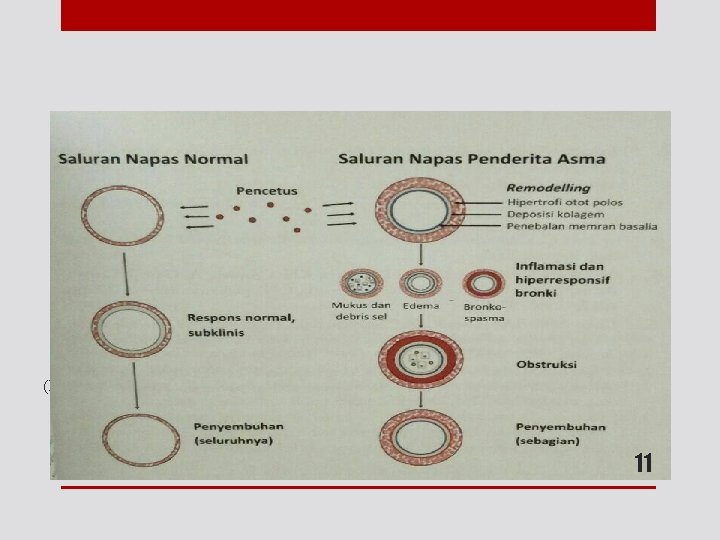 Remodeling Saluran Respiratori pada Asma (Diambil dari ICON 2012) 11 