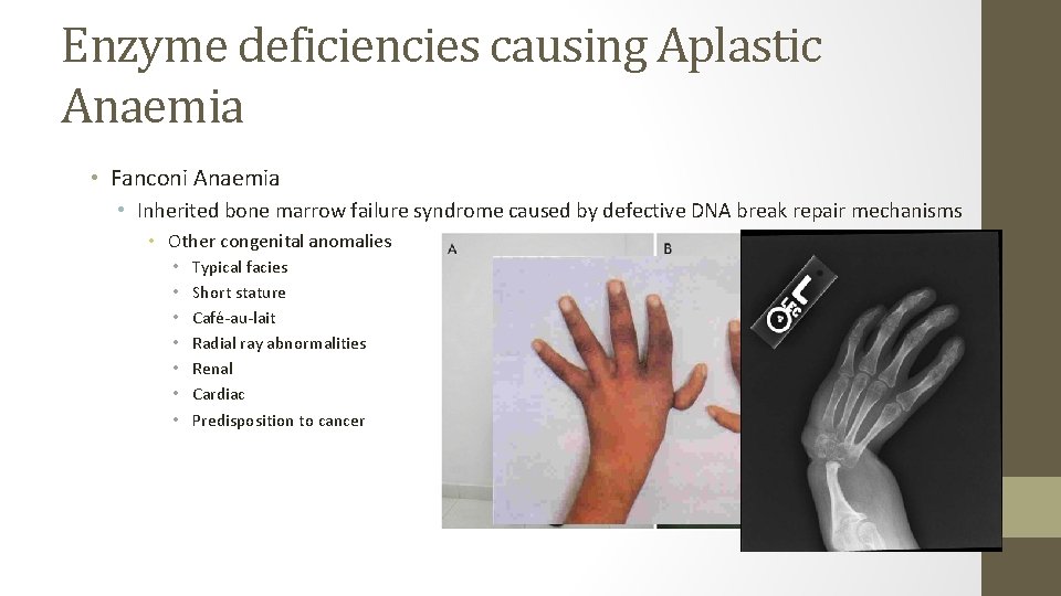 Enzyme deficiencies causing Aplastic Anaemia • Fanconi Anaemia • Inherited bone marrow failure syndrome