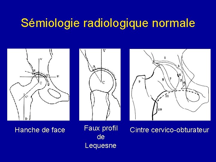 Sémiologie radiologique normale Hanche de face Faux profil de Lequesne Cintre cervico-obturateur Sémiologie radiologique normale Hanche de face Faux profil de Lequesne Cintre cervico-obturateur