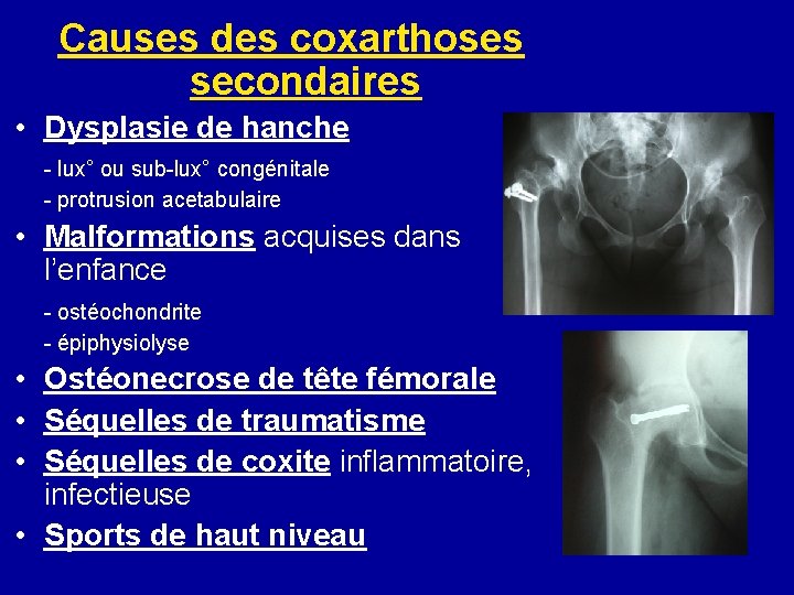 Causes des coxarthoses secondaires • Dysplasie de hanche - lux° ou sub-lux° congénitale - Causes des coxarthoses secondaires • Dysplasie de hanche - lux° ou sub-lux° congénitale -