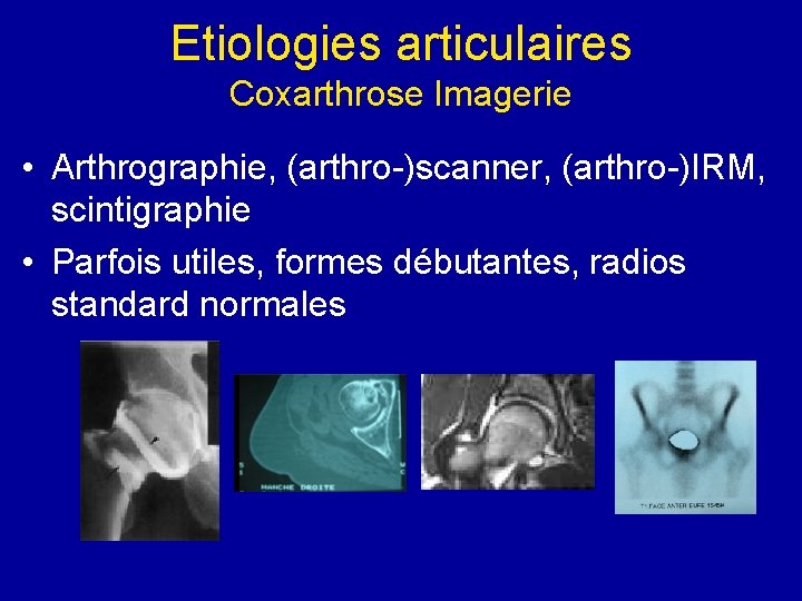 Etiologies articulaires Coxarthrose Imagerie • Arthrographie, (arthro-)scanner, (arthro-)IRM, scintigraphie • Parfois utiles, formes débutantes, Etiologies articulaires Coxarthrose Imagerie • Arthrographie, (arthro-)scanner, (arthro-)IRM, scintigraphie • Parfois utiles, formes débutantes,
