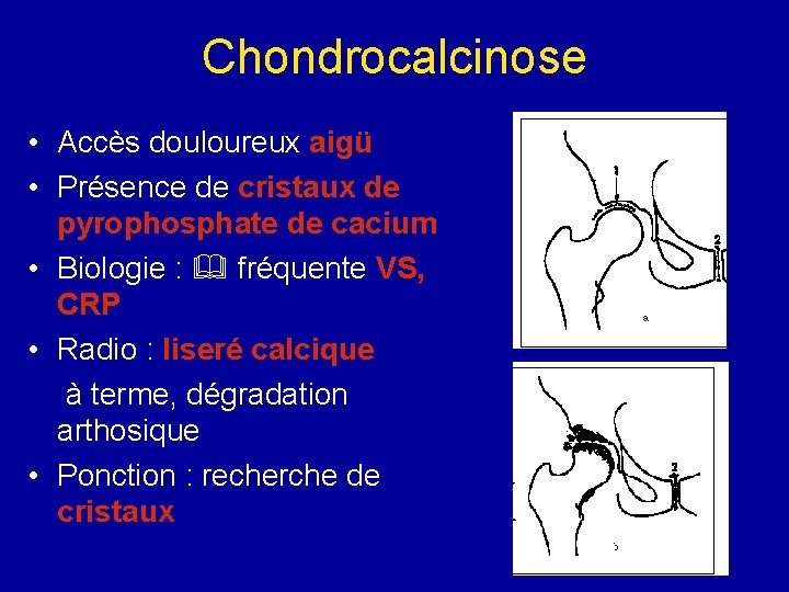 Chondrocalcinose • Accès douloureux aigü • Présence de cristaux de pyrophosphate de cacium •