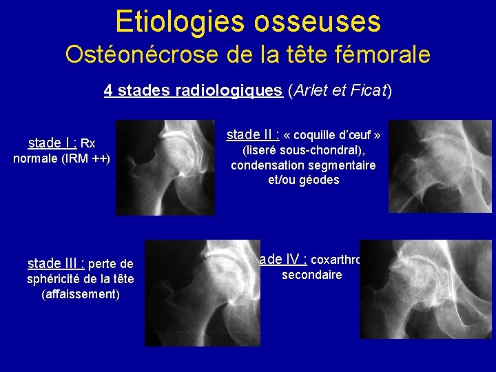 Etiologies osseuses Ostéonécrose de la tête fémorale 4 stades radiologiques (Arlet et Ficat) stade