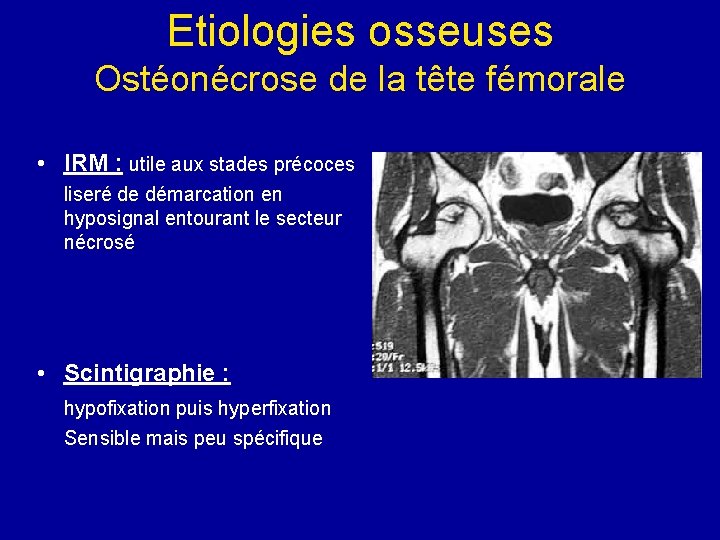 Etiologies osseuses Ostéonécrose de la tête fémorale • IRM : utile aux stades précoces