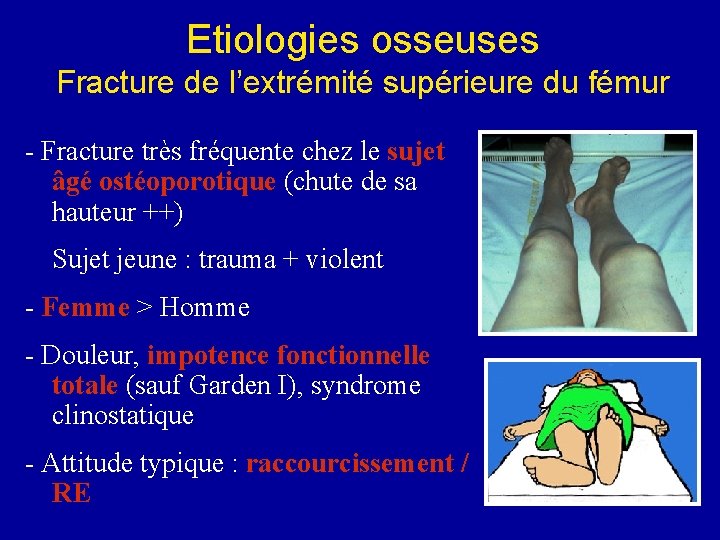 Etiologies osseuses Fracture de l’extrémité supérieure du fémur - Fracture très fréquente chez le Etiologies osseuses Fracture de l’extrémité supérieure du fémur - Fracture très fréquente chez le