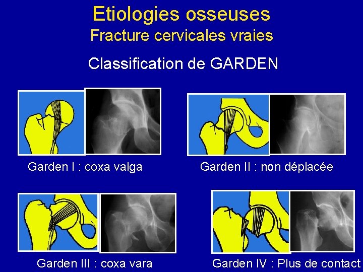 Etiologies osseuses Fracture cervicales vraies Classification de GARDEN Garden I : coxa valga Garden