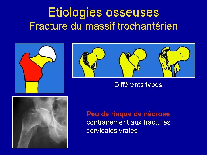 Etiologies osseuses Fracture du massif trochantérien Différents types Peu de risque de nécrose, contrairement