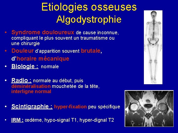 Etiologies osseuses Algodystrophie • Syndrome douloureux de cause inconnue, compliquant le plus souvent un