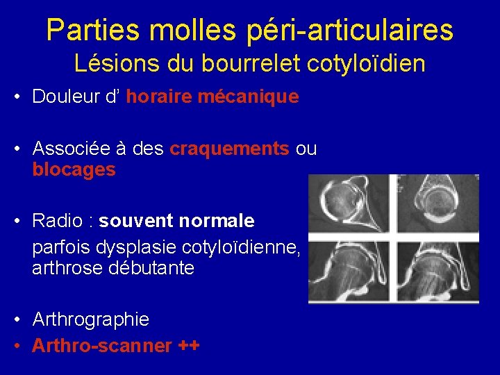 Parties molles péri-articulaires Lésions du bourrelet cotyloïdien • Douleur d’ horaire mécanique • Associée