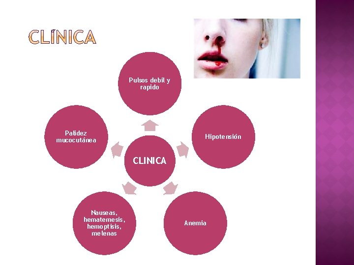 Pulsos debil y rapido Palidez mucocutánea Hipotensión CLINICA Nauseas, hematemesis, hemoptisis, melenas Anemia 