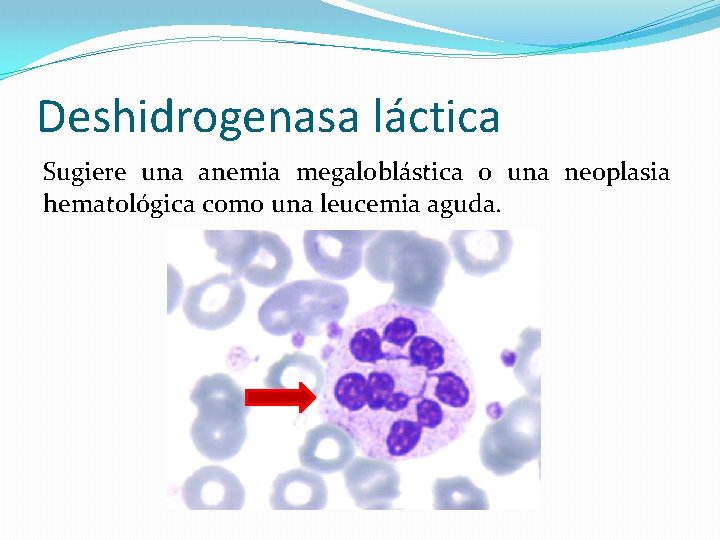 Deshidrogenasa láctica Sugiere una anemia megaloblástica o una neoplasia hematológica como una leucemia aguda. Deshidrogenasa láctica Sugiere una anemia megaloblástica o una neoplasia hematológica como una leucemia aguda.