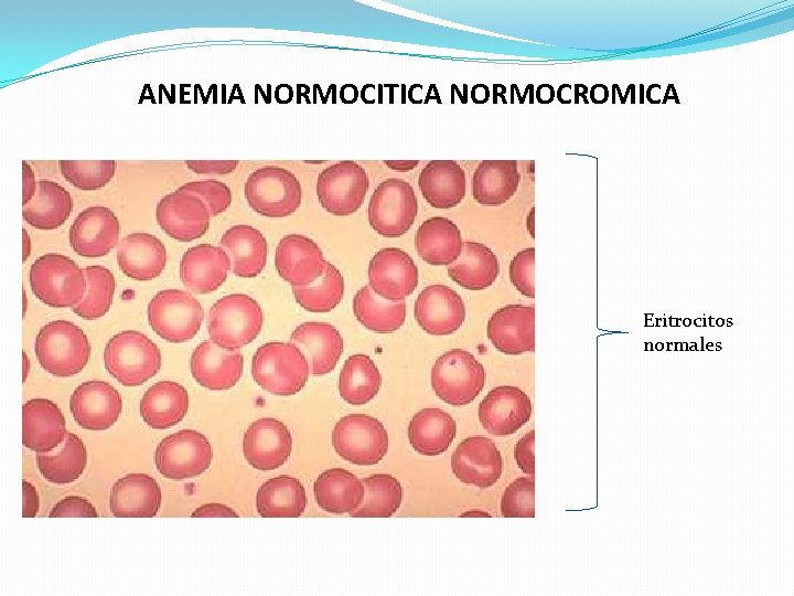ANEMIA NORMOCITICA NORMOCROMICA Eritrocitos normales ANEMIA NORMOCITICA NORMOCROMICA Eritrocitos normales