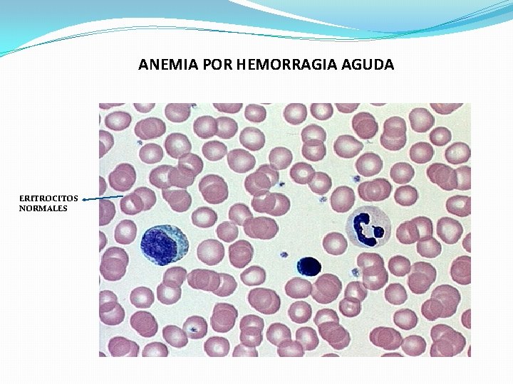 ANEMIA POR HEMORRAGIA AGUDA ERITROCITOS NORMALES ANEMIA POR HEMORRAGIA AGUDA ERITROCITOS NORMALES