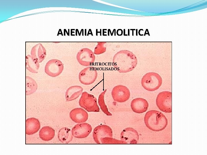 ANEMIA HEMOLITICA ERITROCITOS HEMOLISADOS ANEMIA HEMOLITICA ERITROCITOS HEMOLISADOS