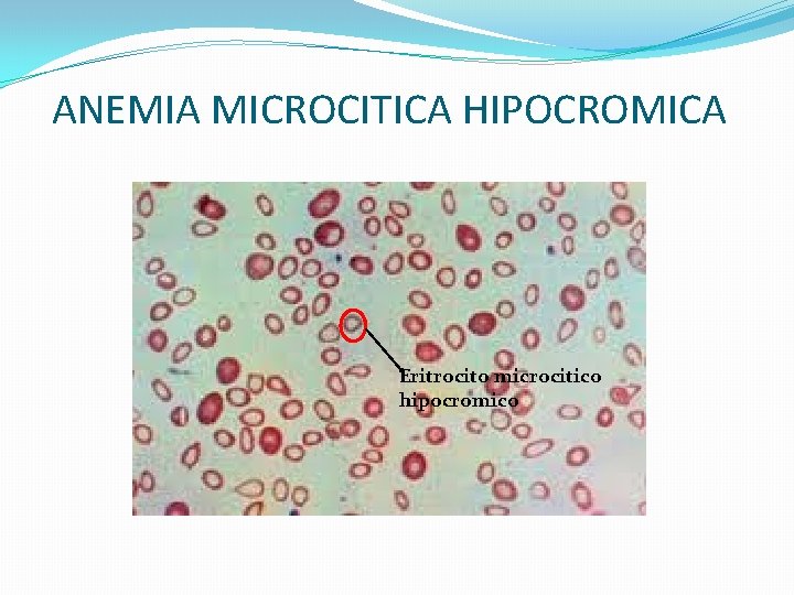 ANEMIA MICROCITICA HIPOCROMICA Eritrocito microcitico hipocromico ANEMIA MICROCITICA HIPOCROMICA Eritrocito microcitico hipocromico