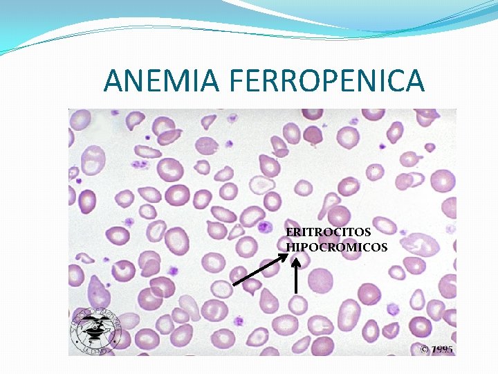 ANEMIA FERROPENICA ERITROCITOS HIPOCROMICOS ANEMIA FERROPENICA ERITROCITOS HIPOCROMICOS