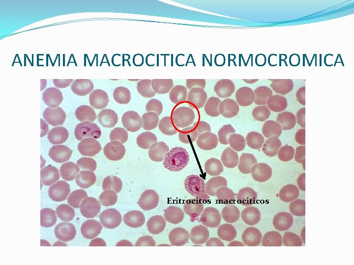 ANEMIA MACROCITICA NORMOCROMICA Eritrocitos macrociticos ANEMIA MACROCITICA NORMOCROMICA Eritrocitos macrociticos